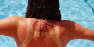 sunburn treatment